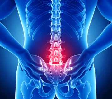 sciatica